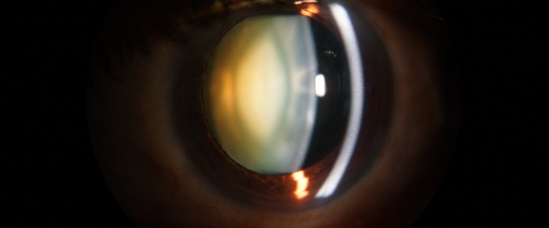 What can be seen on slit lamp?