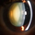 What can be seen on slit lamp?